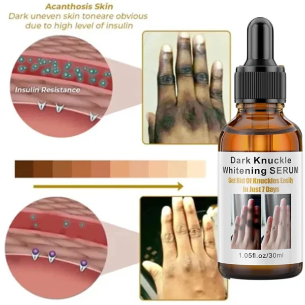 Dark Knuckles Fast Whitening Serum Mão Knuckle Cotovelos Joelho Corretor de Melanina Removedor de Manchas Intensas Produtos Cuidados de Beleza 30ml - Imagem 4
