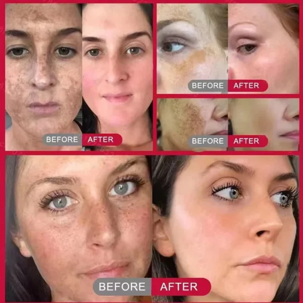 Creme facial clareador para remoção de sardas, melasma, corretivo para manchas escuras, clareia a pigmentação da melanina, clareia, antienvelhecimento, cuidados de beleza - Imagem 2