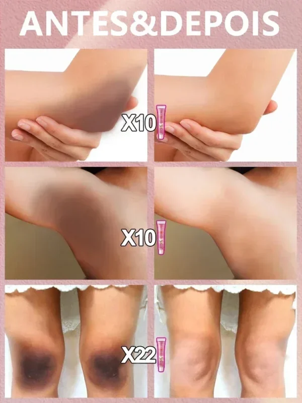 Creme Clareador Partes Íntimas Axilas Clarear Sérum Bumbum Joelho Remover Melanina Clarear Cuidados de Beleza Melanina - Imagem 4