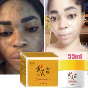 Creme facial clareador para remoção de sardas, melasma, corretivo para manchas escuras, clareia a pigmentação da melanina, clareia, antienvelhecimento, cuidados de beleza