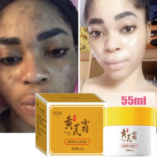 Creme facial clareador para remoção de sardas, melasma, corretivo para manchas escuras, clareia a pigmentação da melanina, clareia, antienvelhecimento, cuidados de beleza