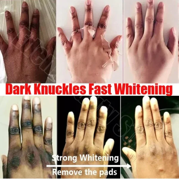 Dark Knuckles Fast Whitening Serum Mão Knuckle Cotovelos Joelho Corretor de Melanina Removedor de Manchas Intensas Produtos Cuidados de Beleza 30ml - Imagem 5