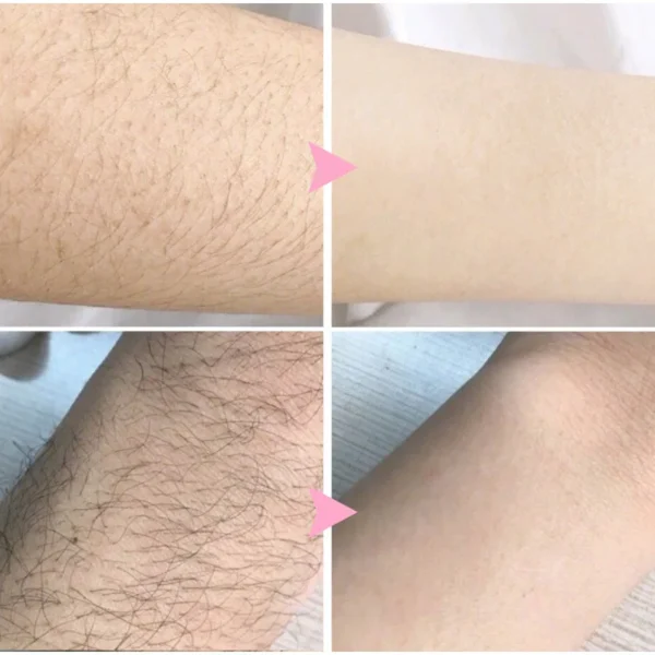 Spray de depilação rápida para homens e mulheres, inibidor indolor do crescimento do cabelo, axila do braço, perna depilatória permanente, beleza saúde, 10pcs - Imagem 4