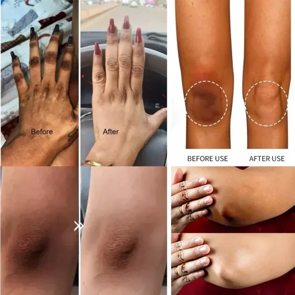 Dark Knuckles Fast Whitening Serum Mão Knuckle Cotovelos Joelho Corretor de Melanina Removedor de Manchas Intensas Produtos Cuidados de Beleza 30ml - Imagem 3
