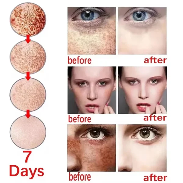 Creme facial clareador para remoção de sardas, melasma, corretivo para manchas escuras, clareia a pigmentação da melanina, clareia, antienvelhecimento, cuidados de beleza - Imagem 4