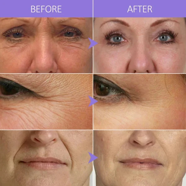 Colágeno Soro Facial Remoção de Rugas Antienvelhecimento Ácido Hialurônico Testa Facial Linhas Finas Lifting Serum Cuidados com a Pele Beleza 40ml - Imagem 4